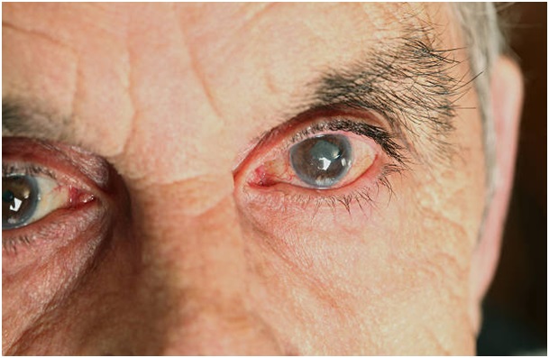 Most Asked Questions About Glaucoma