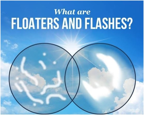 floaters and flashes in the eyes