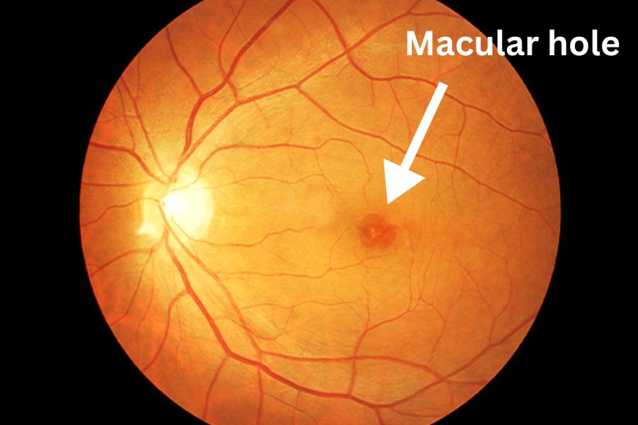 Macular Holes treatment at delhi eye care