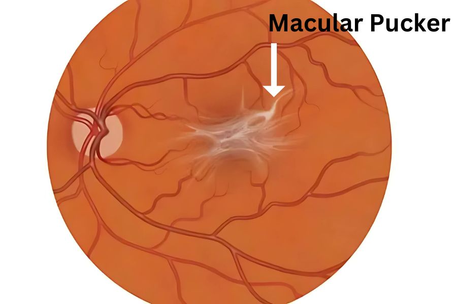 Pucker Holes treatment at delhi eye care