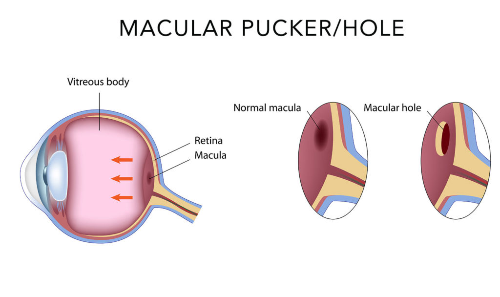 Macular Holes and Puckers treatment at delhi eye care