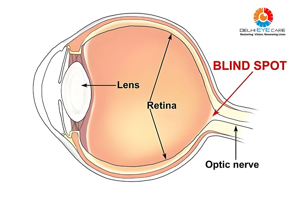 the Blind Spot in the Retina