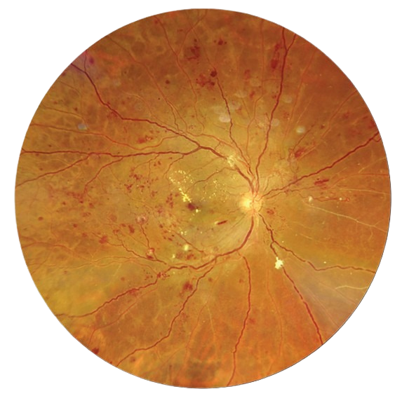 Diabetic retina examination