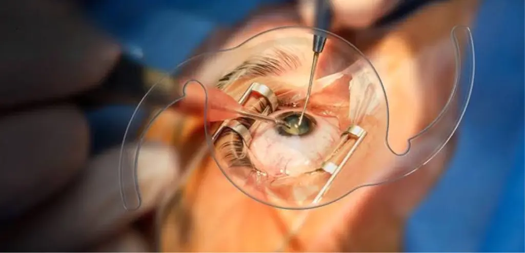 Close view of cataract surgery under an operating microscope