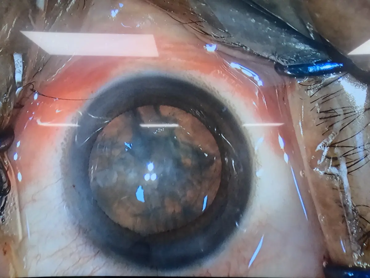 Cataract assessed under magnification