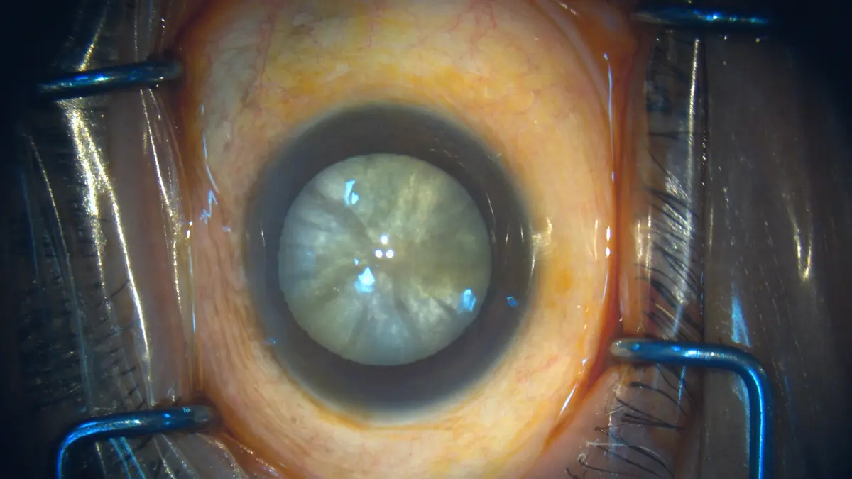 Dense cataract seen during eye examination