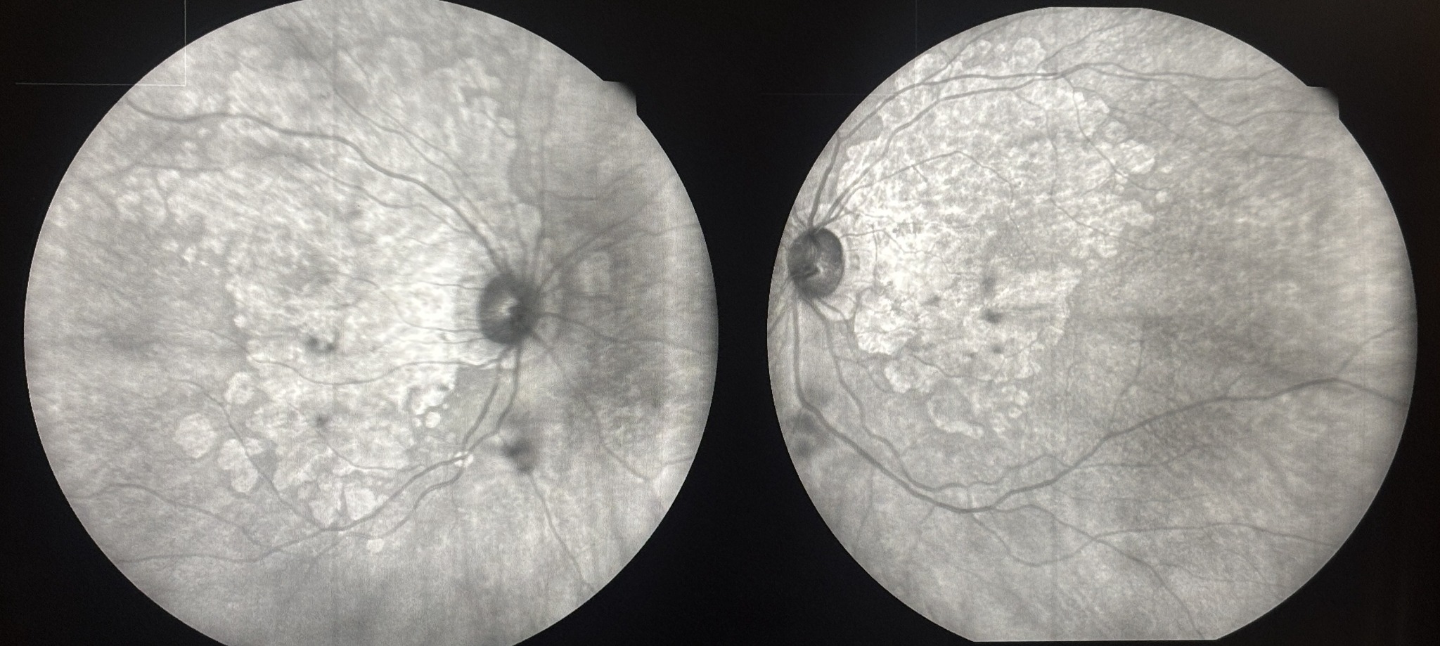 Bilateral fundus autofluorescence images showing age-related macular degeneration