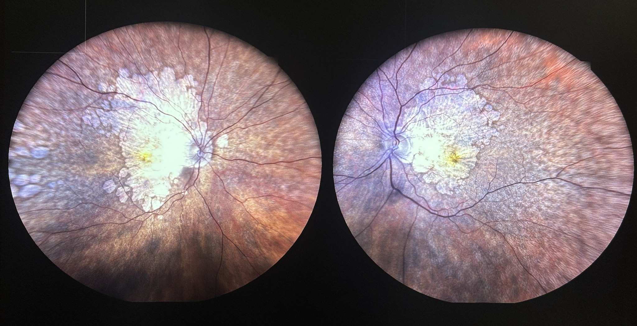 Bilateral wide-field colour retinal photographs showing age-related macular degeneration
