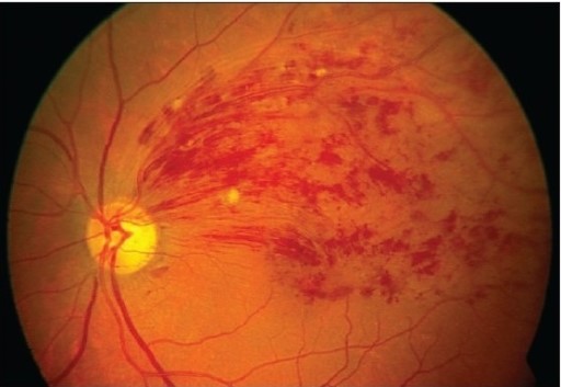 Retinal photograph showing branch retinal vein occlusion