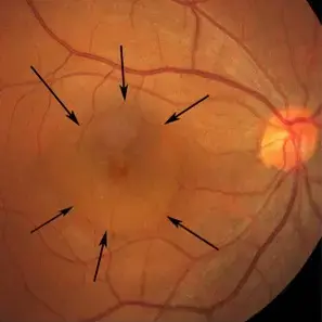 Colour retinal photograph showing central serous chorioretinopathy