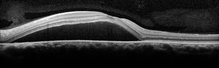 OCT scan showing subretinal fluid in CSCR
