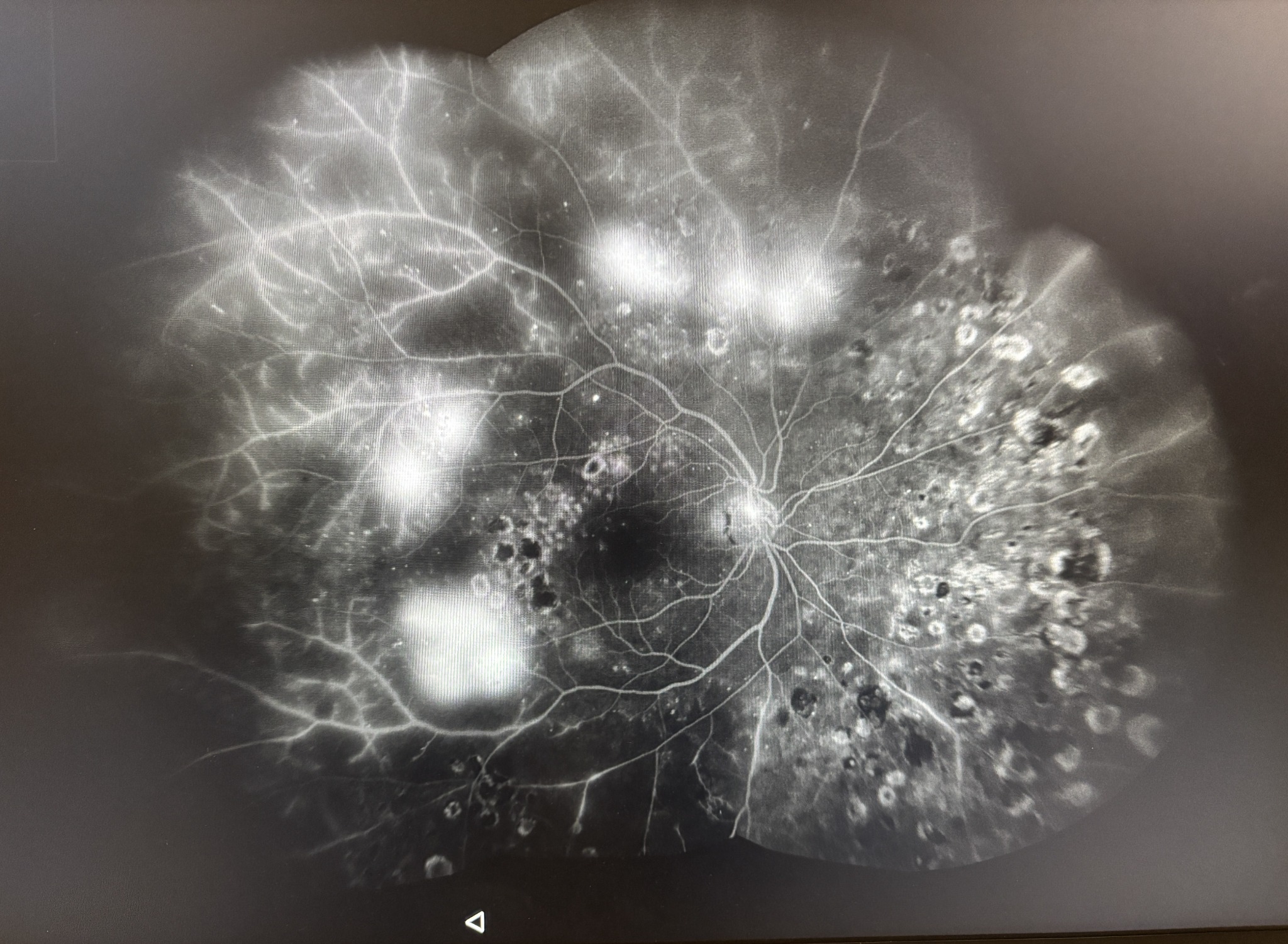 Wide-field retinal angiography in diabetic retinopathy