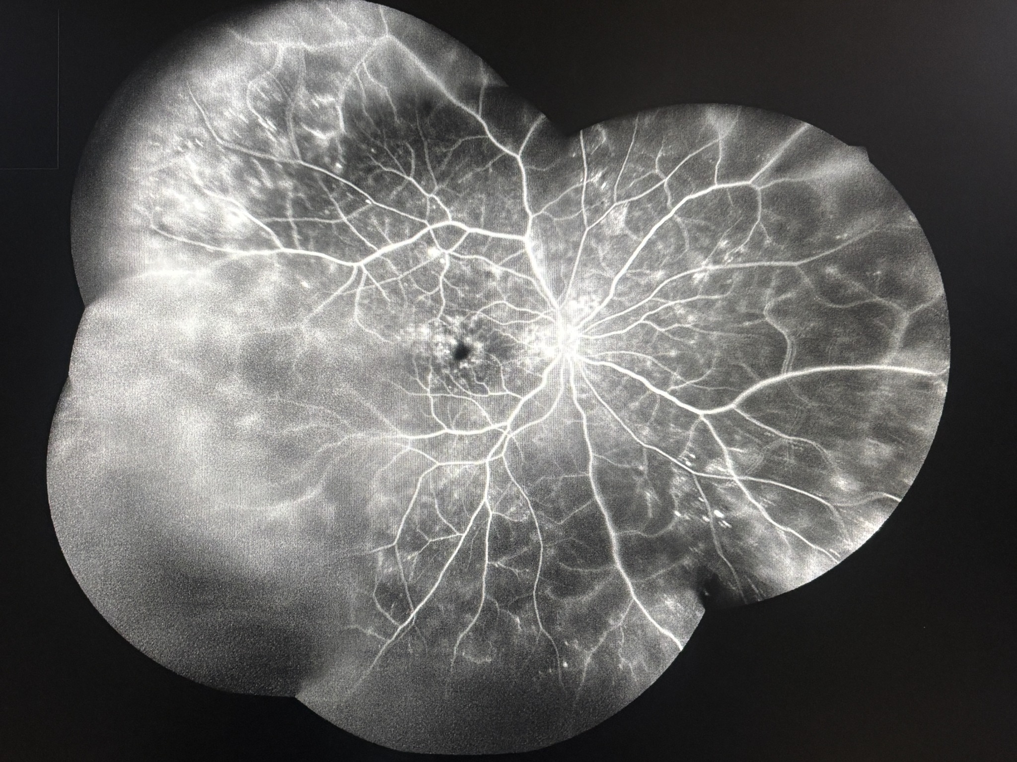 Retinal angiography demonstrating vascular changes in diabetic retinopathy