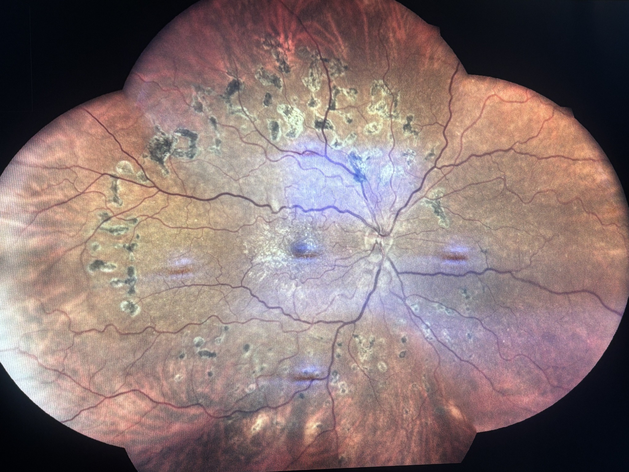 Wide-field colour retinal photograph showing diabetic retinal changes