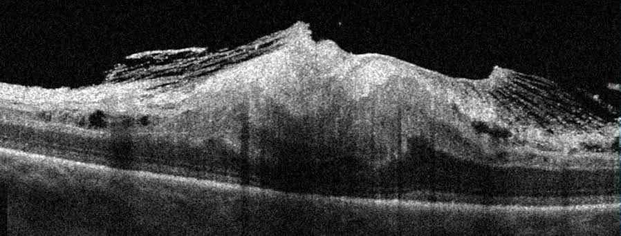 OCT scan showing an epiretinal membrane with macular surface distortion