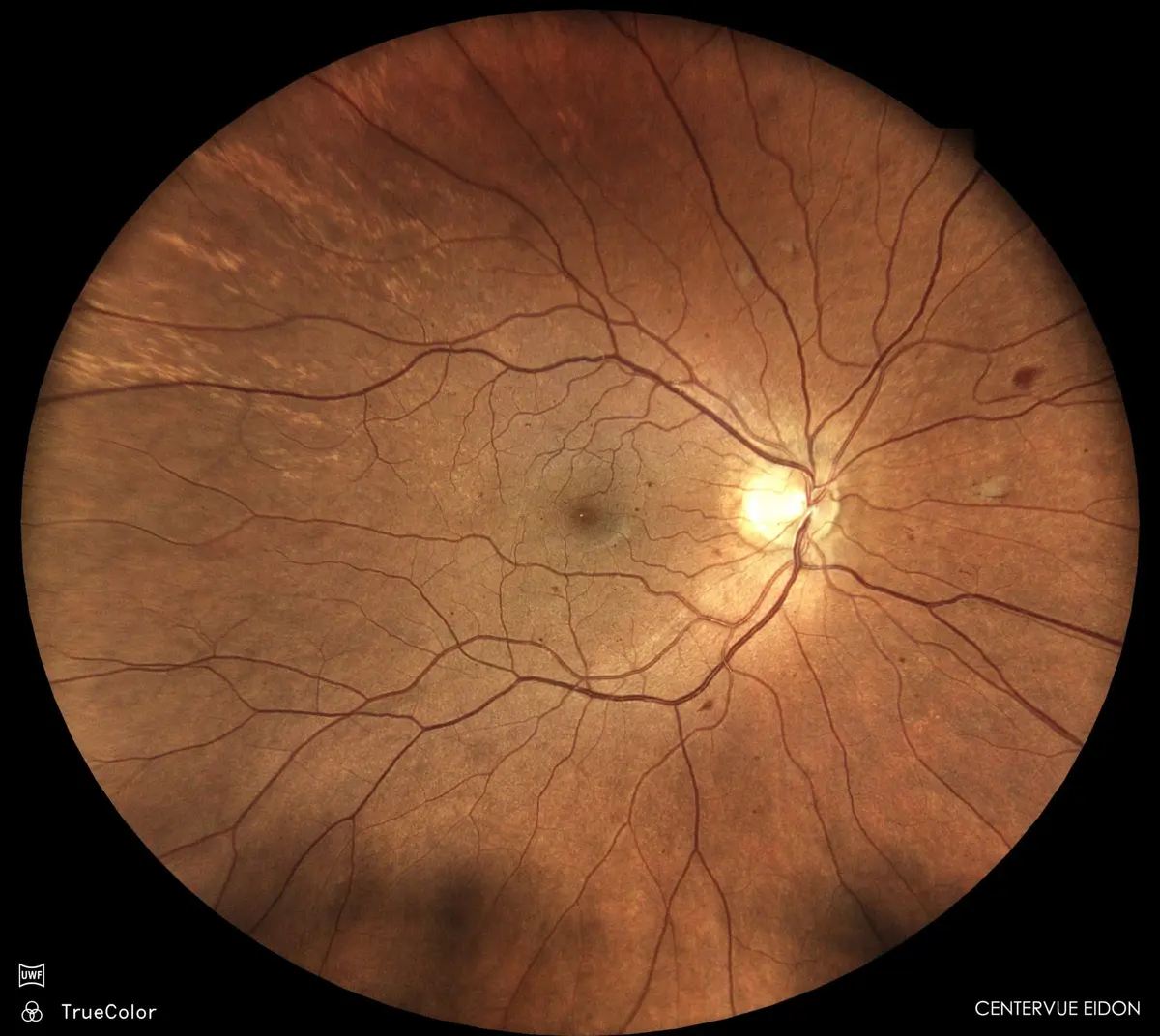 Ultra-wide-field colour photograph of the retina