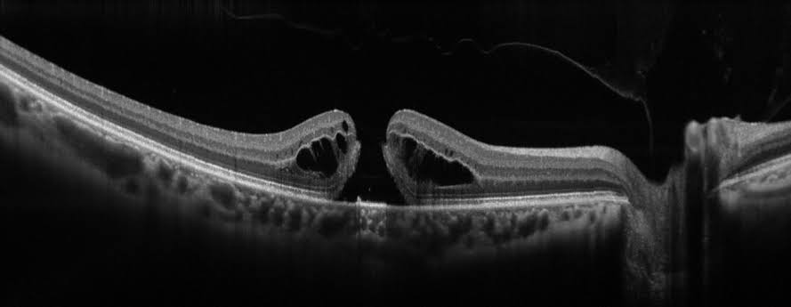 OCT scan showing a full-thickness macular hole