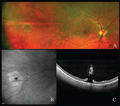 Multimodal retinal imaging with wide-field fundus, infrared and OCT views