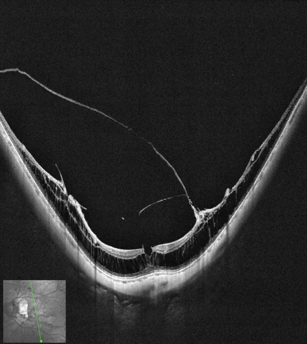 OCT showing myopic traction maculopathy in an elongated eye