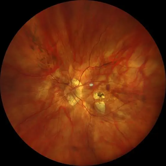 Fundus photograph showing pathological myopic retinal and macular changes