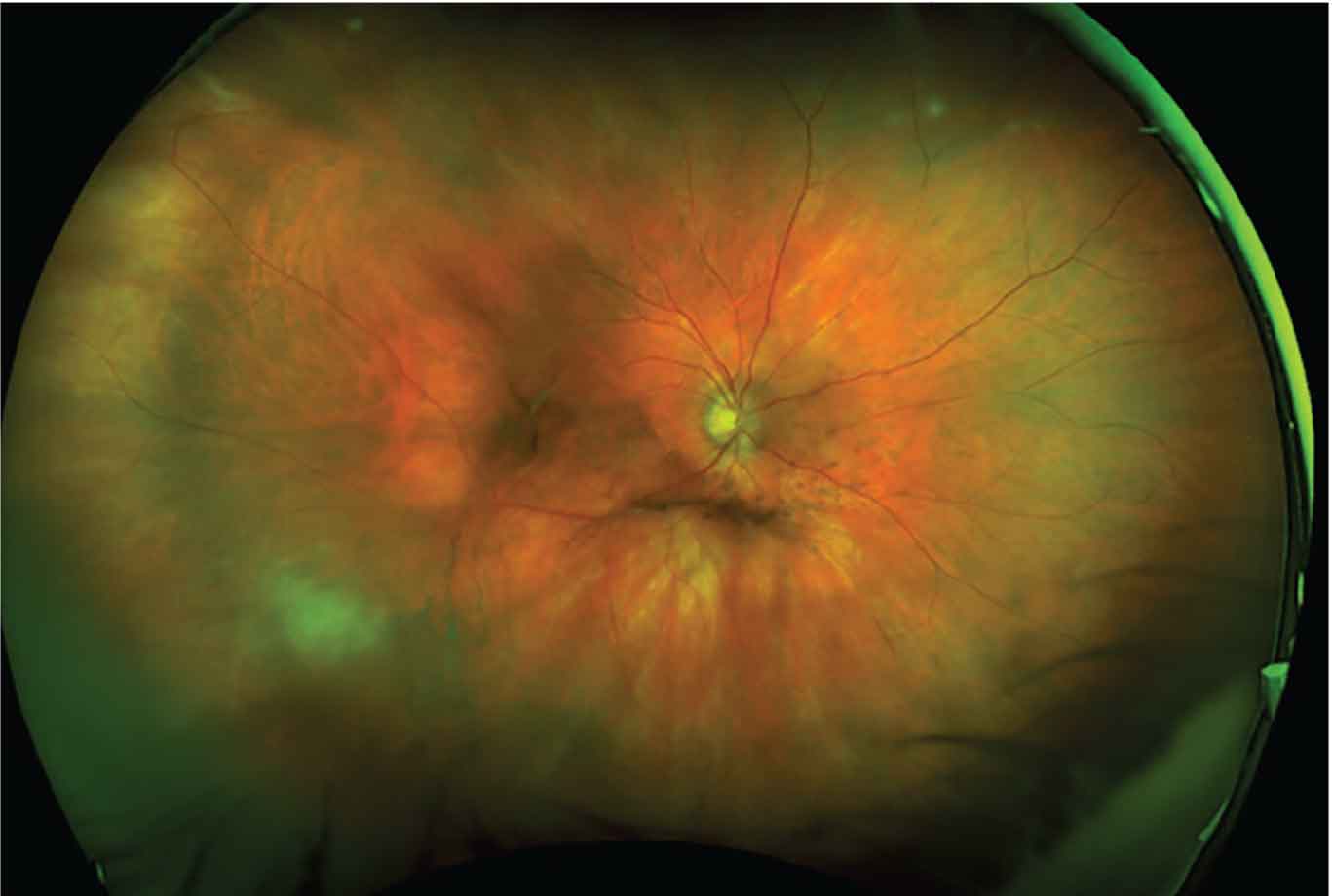 Wide-field retinal photograph showing a persistent vitreous opacity