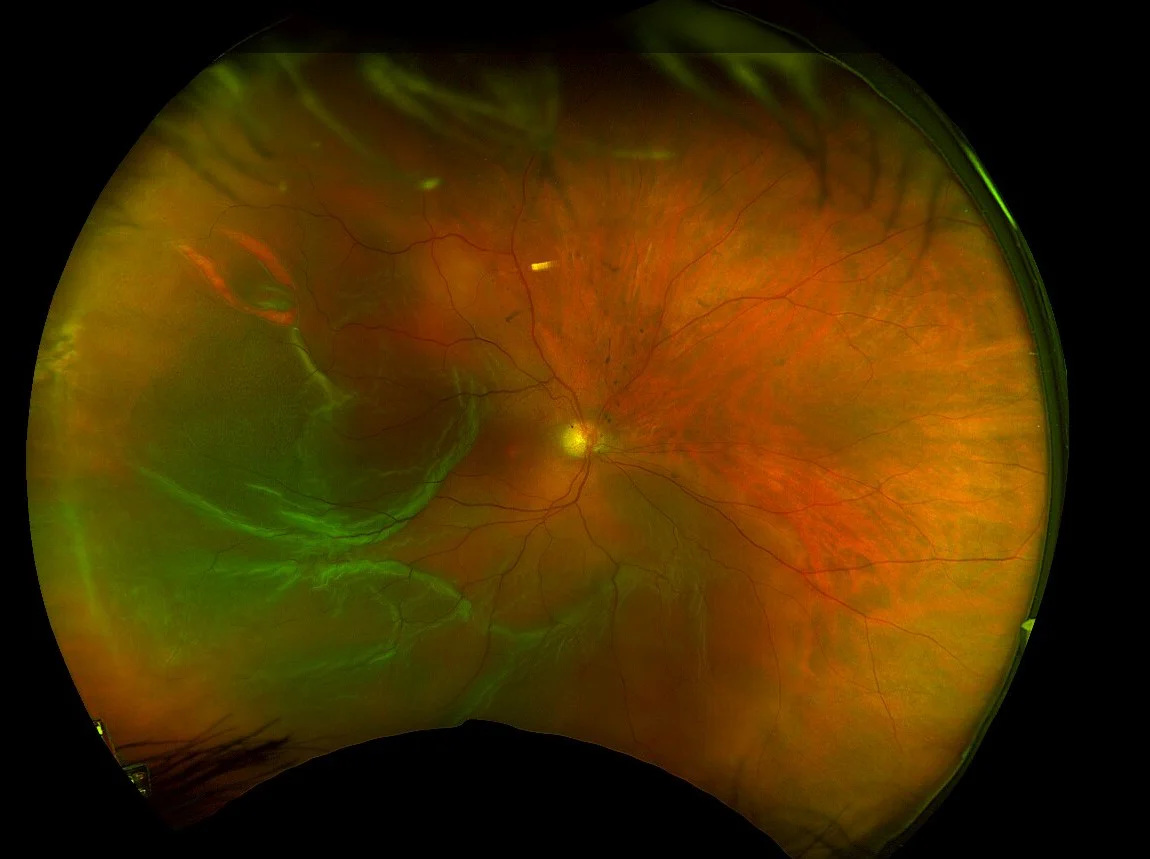 Ultra-wide-field retinal photograph showing retinal detachment