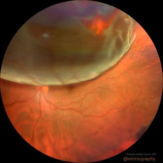 Wide-field retinal photograph showing a retinal detachment