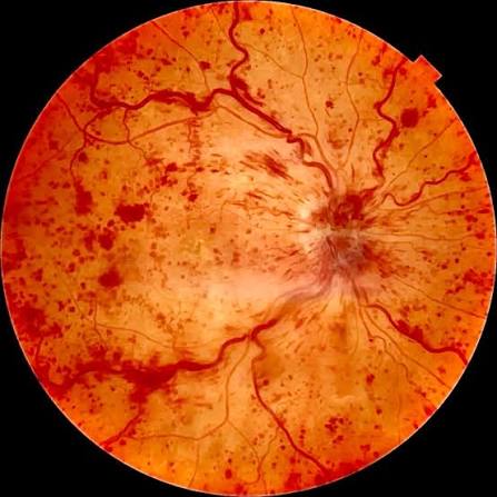 Retinal photograph showing central retinal vein occlusion
