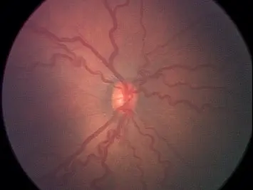 Infant retinal photograph showing posterior vessel dilatation and tortuosity