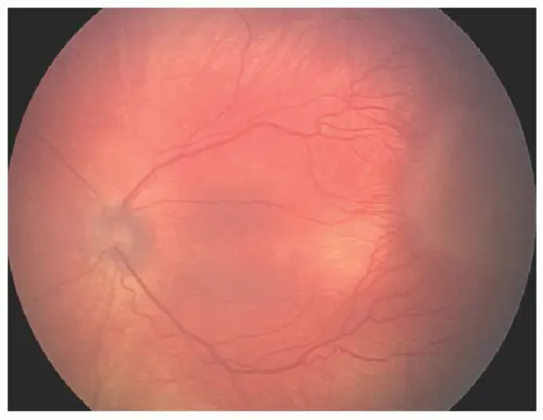 Infant retinal photograph used during ROP screening