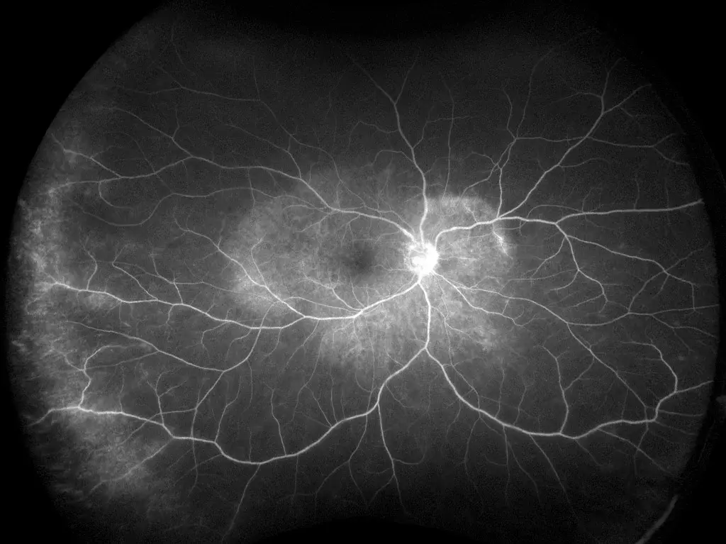 Wide-field fluorescein angiography used in uveitis assessment