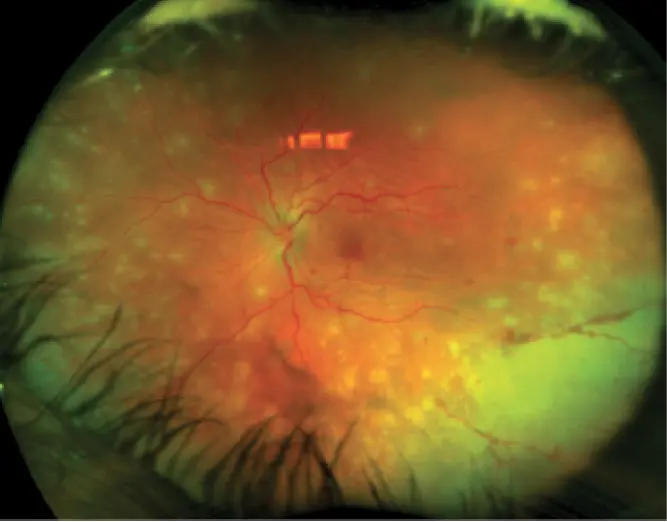 Wide-field colour retinal photograph showing posterior inflammatory changes
