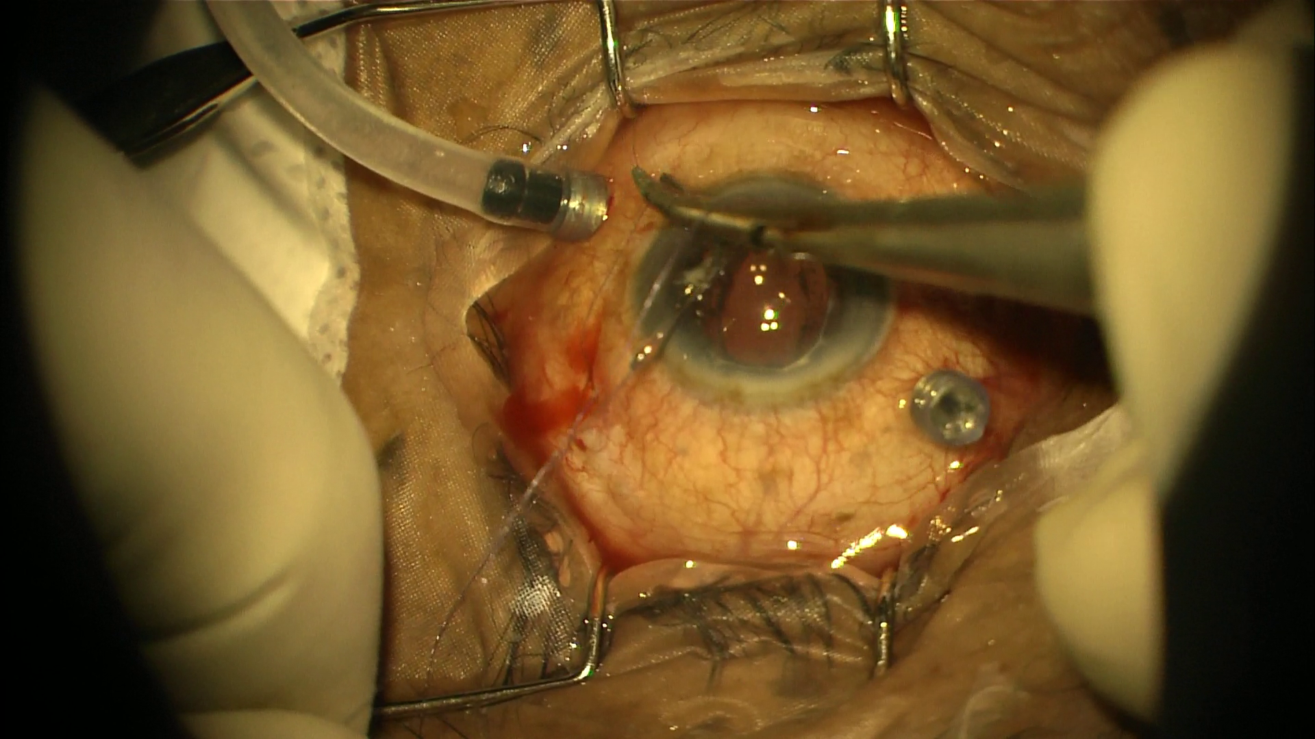 Vitrectomy surgery being performed through small entry ports in the eye