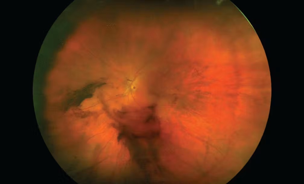 Wide-field retinal photograph showing vitreous haemorrhage obscuring the retinal view